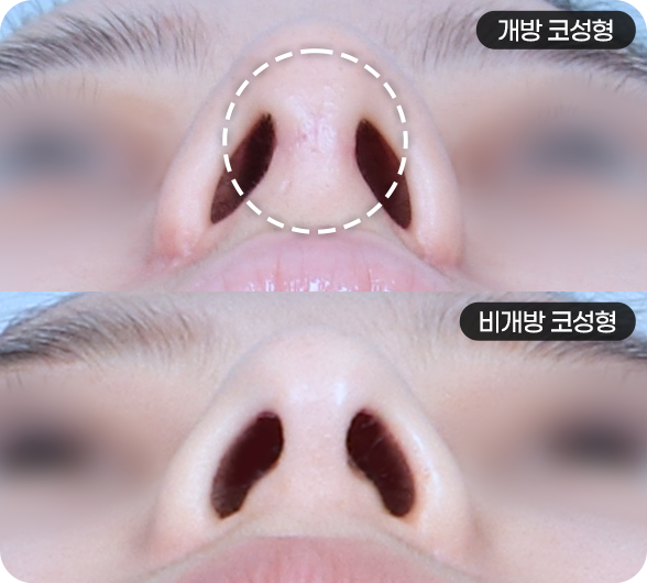 비개방코성형이미지