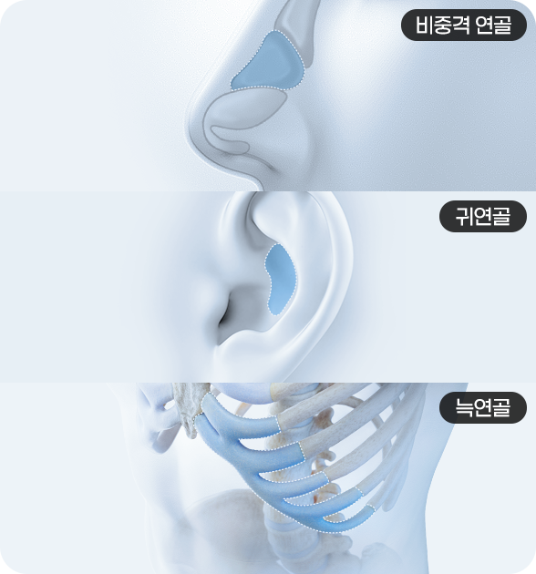 자가연골사용이미지