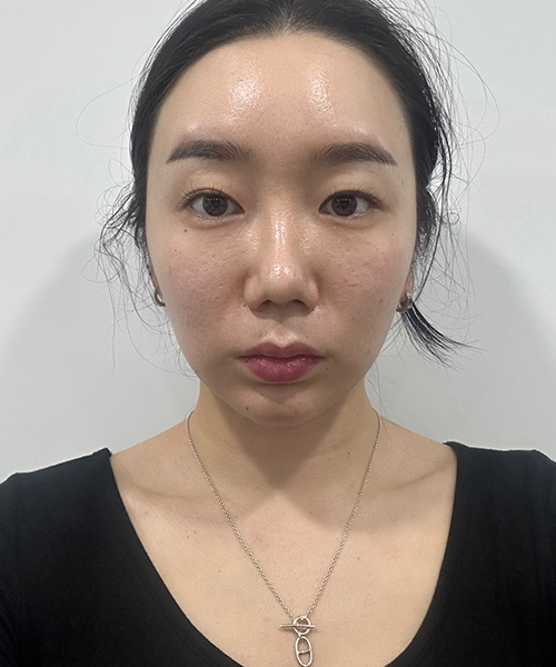 수술 전