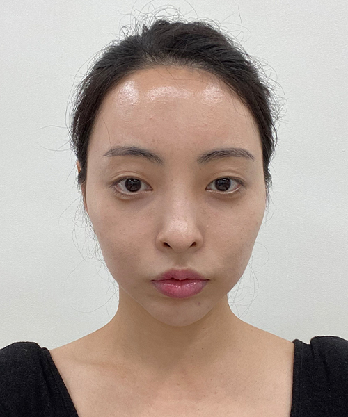수술 전