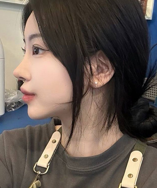 수술 후 3개월
