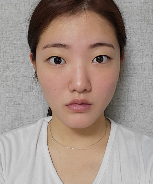 수술 전
