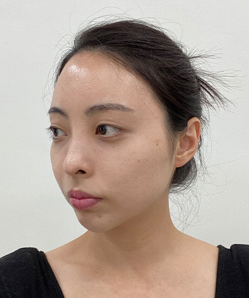 수술 전