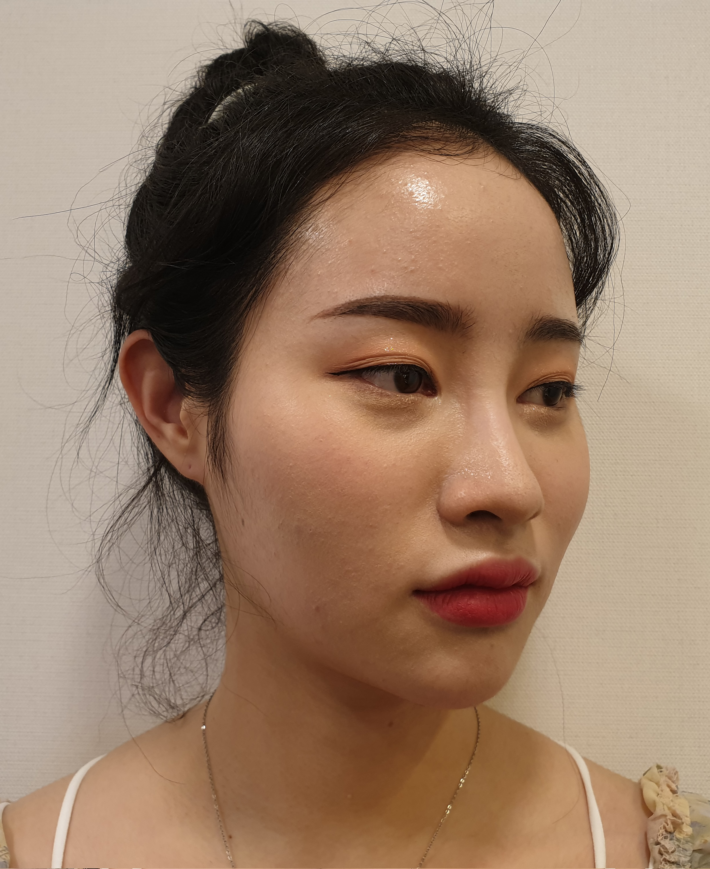 수술 전
