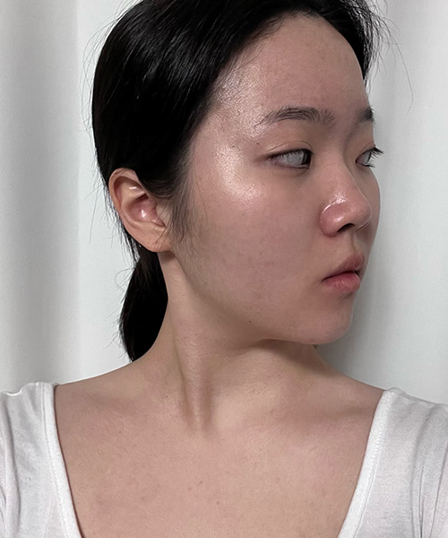 수술 전