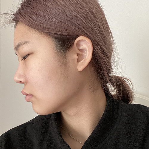 수술 전